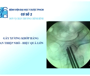 Gãy Xương khớp háng: can thiệp nhỏ, hiệu quả lớn