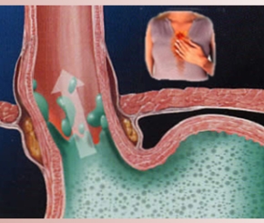 Các yếu tố khởi phát cơn hen