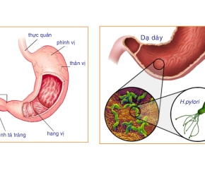 Bệnh viêm loét dạ dày tá tràng